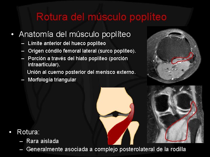 Rotura del músculo poplíteo • Anatomía del músculo poplíteo – Límite anterior del hueco