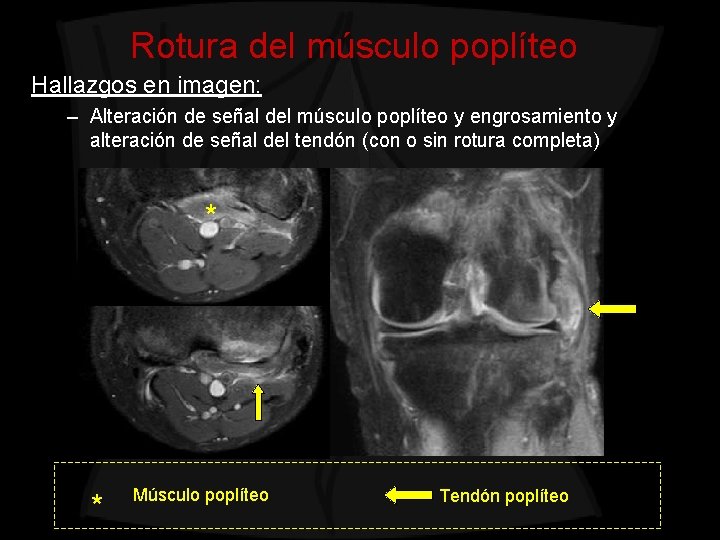 Rotura del músculo poplíteo Hallazgos en imagen: – Alteración de señal del músculo poplíteo