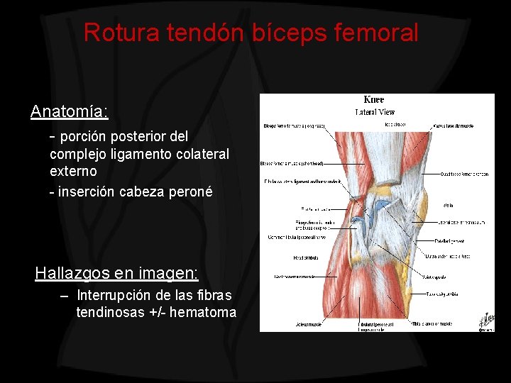 Rotura tendón bíceps femoral Anatomía: - porción posterior del complejo ligamento colateral externo -