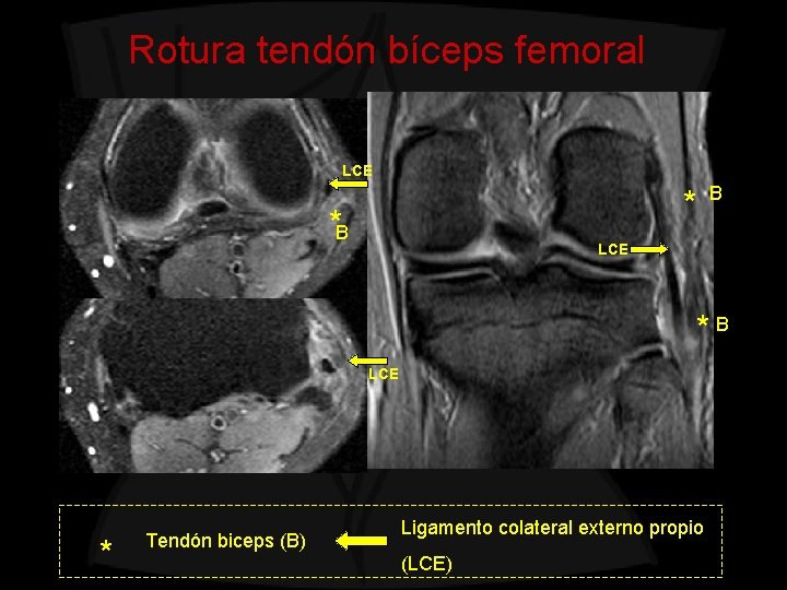 Rotura tendón bíceps femoral LCE * *B B LCE * Tendón biceps (B) Ligamento