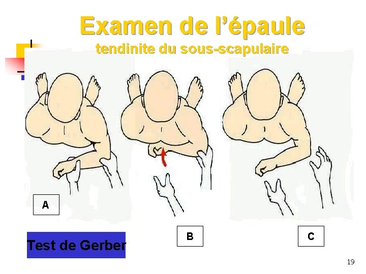 Examen de l’épaule tendinite du sous-scapulaire A Test de Gerber B C 19 