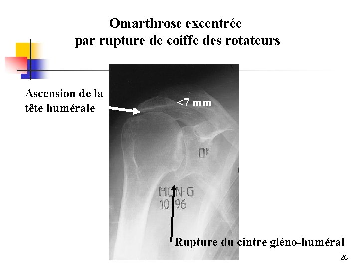 Omarthrose excentrée par rupture de coiffe des rotateurs Ascension de la tête humérale <7