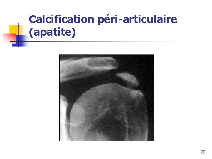 Calcification péri-articulaire (apatite) 28 
