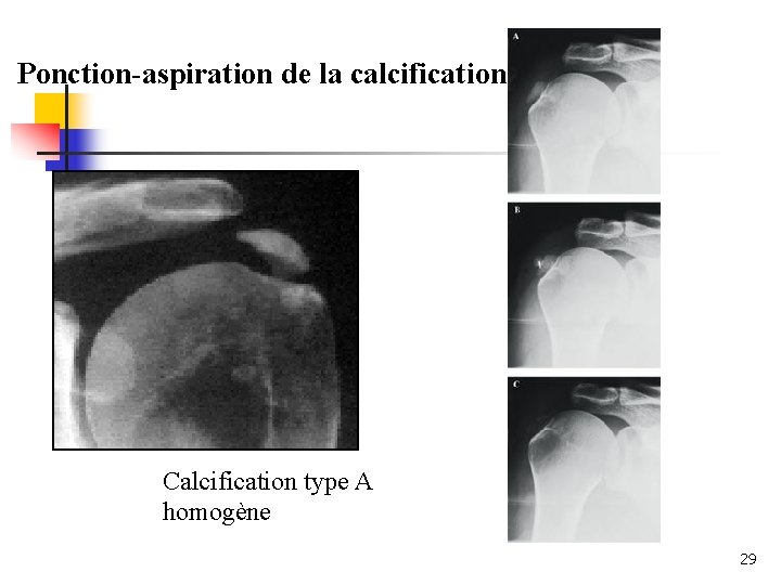 Ponction-aspiration de la calcification Calcification type A homogène 29 