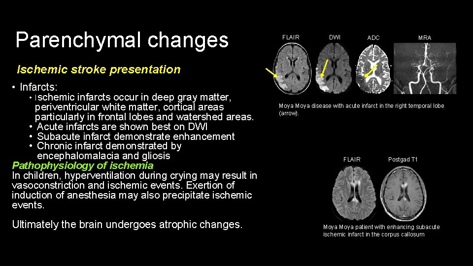 Parenchymal changes FLAIR DWI ADC MRA Ischemic stroke presentation • Infarcts: • Ischemic infarcts