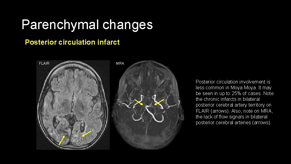 Parenchymal changes Posterior circulation infarct FLAIR MRA Posterior circulation involvement is less common in