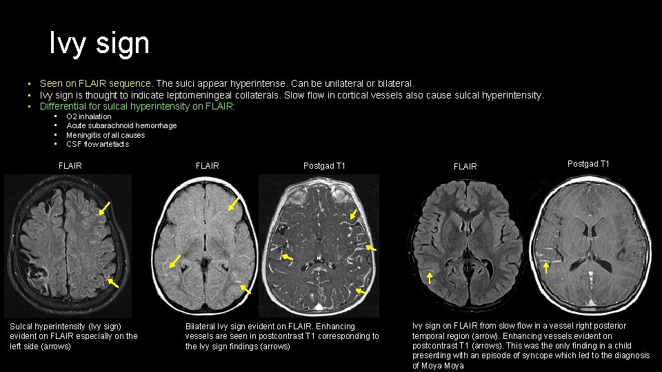 Ivy sign • Seen on FLAIR sequence. The sulci appear hyperintense. Can be unilateral