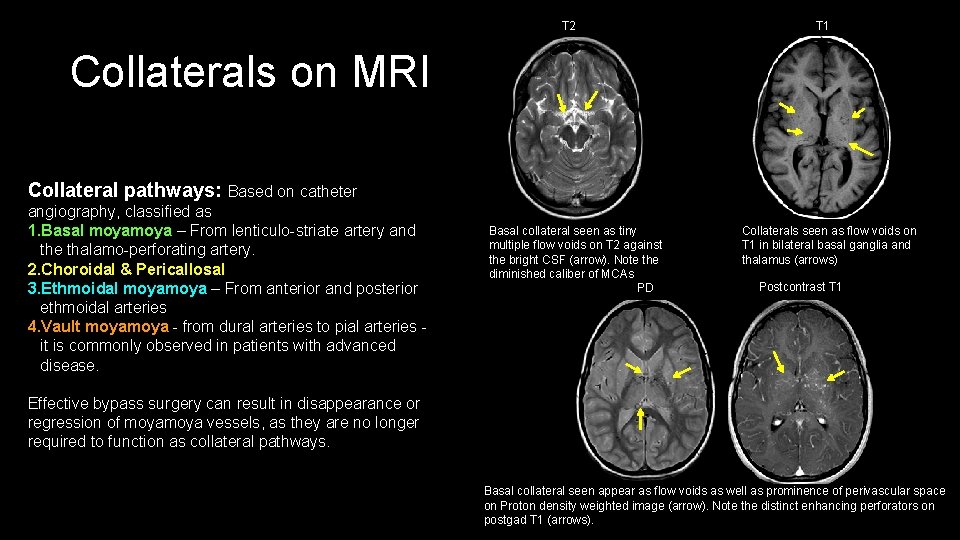 T 2 T 1 Collaterals on MRI Collateral pathways: Based on catheter angiography, classified