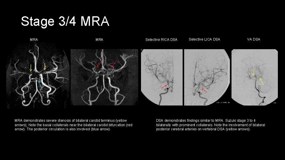 Stage 3/4 MRA MRA demonstrates severe stenosis of bilateral carotid terminus (yellow arrows); Note