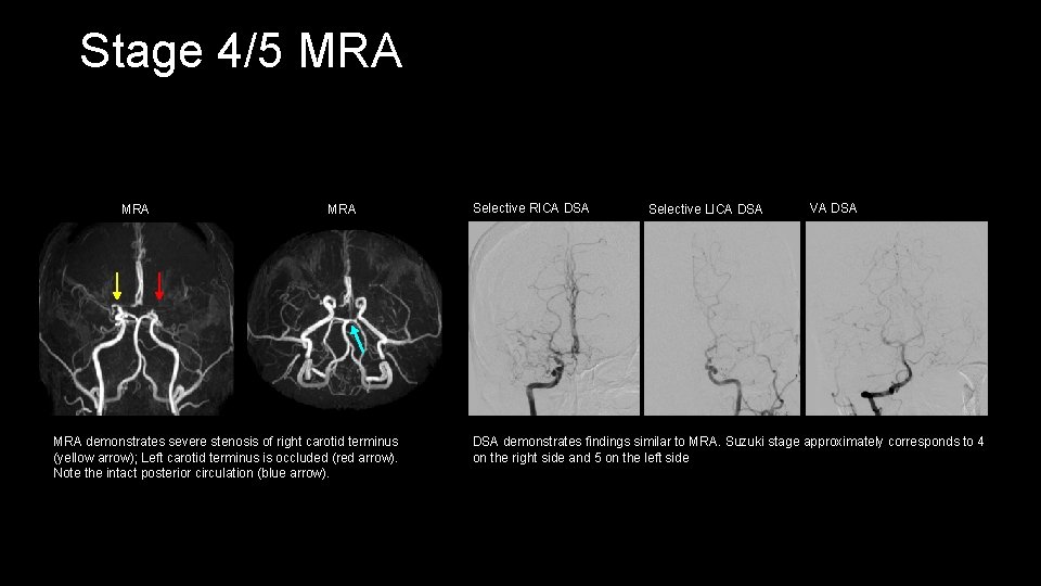 Stage 4/5 MRA MRA demonstrates severe stenosis of right carotid terminus (yellow arrow); Left