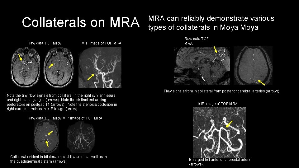 Collaterals on MRA Raw data TOF MRA MIP image of TOF MRA can reliably