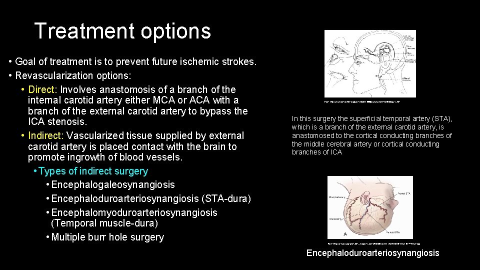 Treatment options • Goal of treatment is to prevent future ischemic strokes. • Revascularization