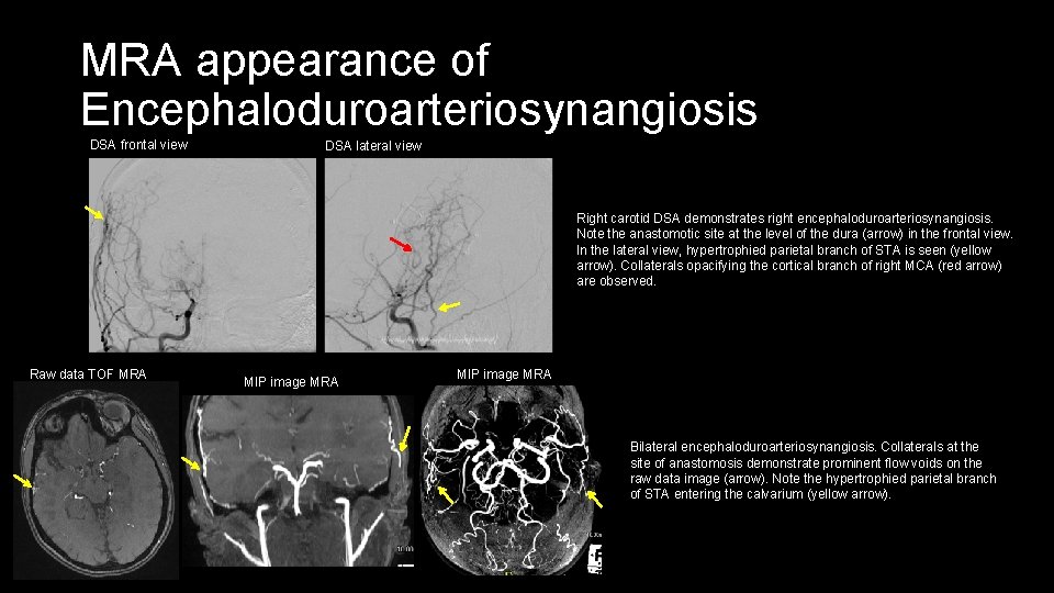 MRA appearance of Encephaloduroarteriosynangiosis DSA frontal view DSA lateral view Right carotid DSA demonstrates