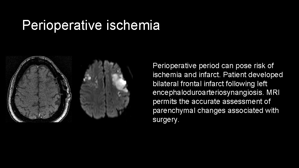 Perioperative ischemia Perioperative period can pose risk of ischemia and infarct. Patient developed bilateral