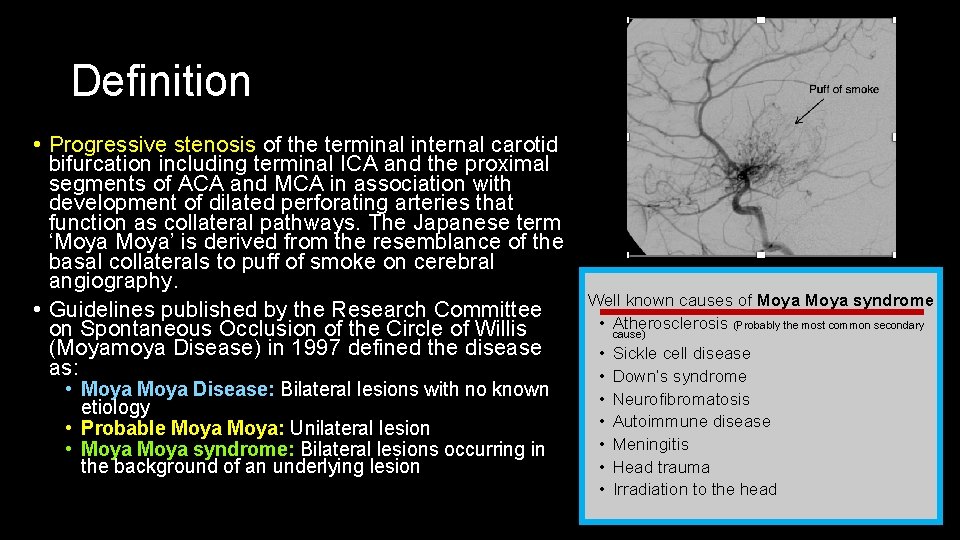 Definition • Progressive stenosis of the terminal internal carotid bifurcation including terminal ICA and