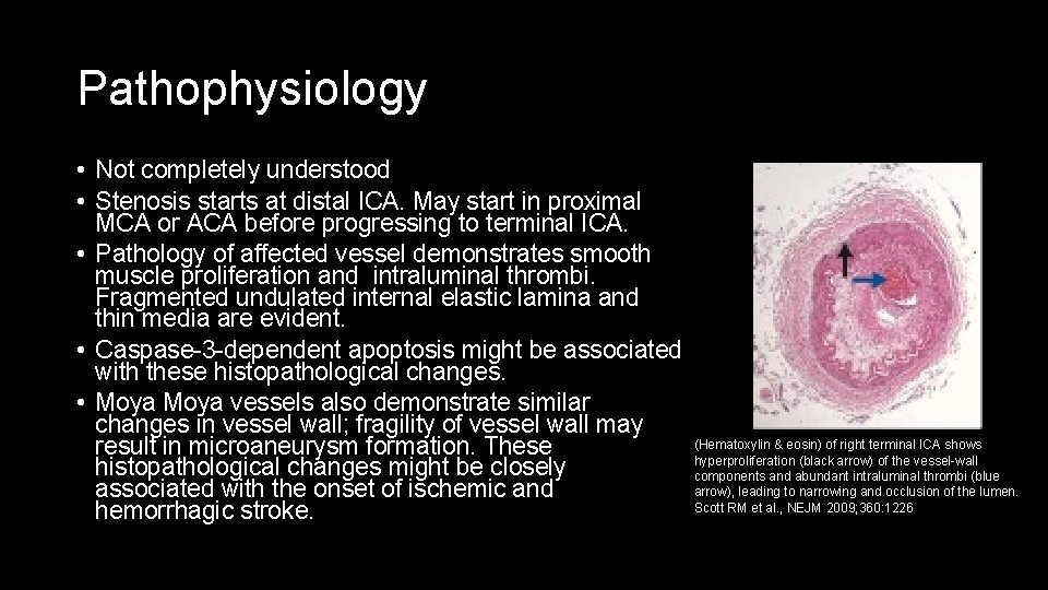 Pathophysiology • Not completely understood • Stenosis starts at distal ICA. May start in