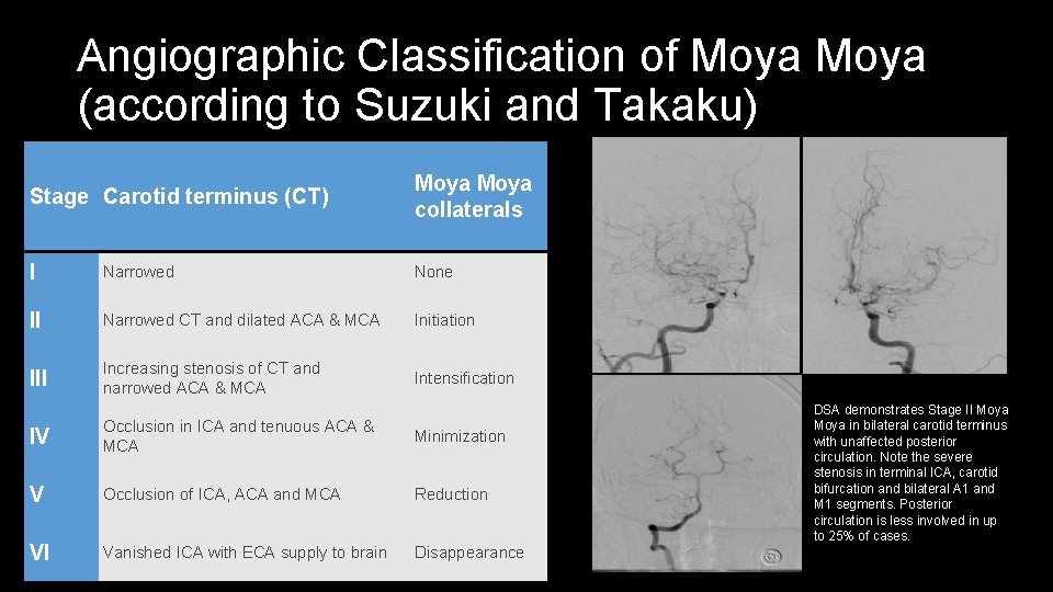 Angiographic Classification of Moya (according to Suzuki and Takaku) Stage Carotid terminus (CT) Moya