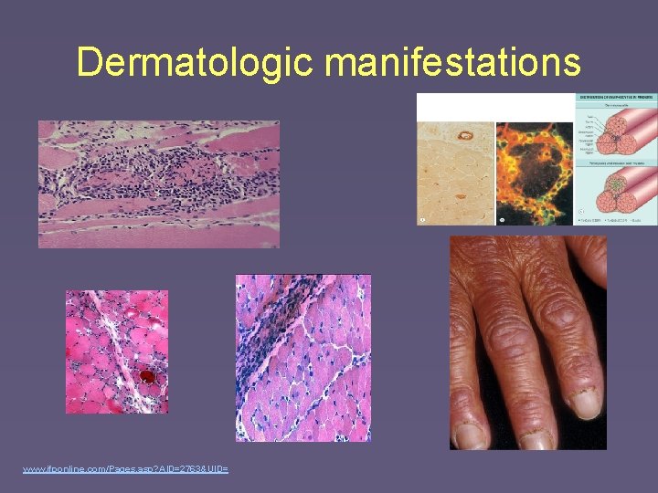 Dermatologic manifestations www. jfponline. com/Pages. asp? AID=2763&UID= 