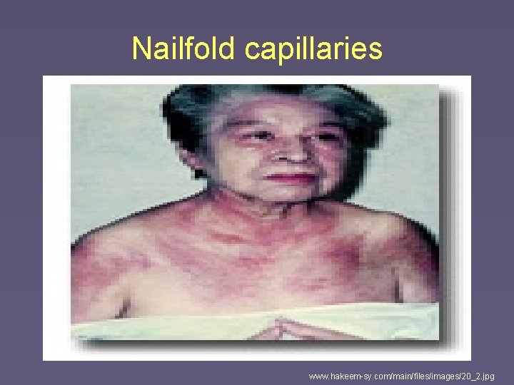 Nailfold capillaries www. hakeem-sy. com/main/files/images/20_2. jpg 