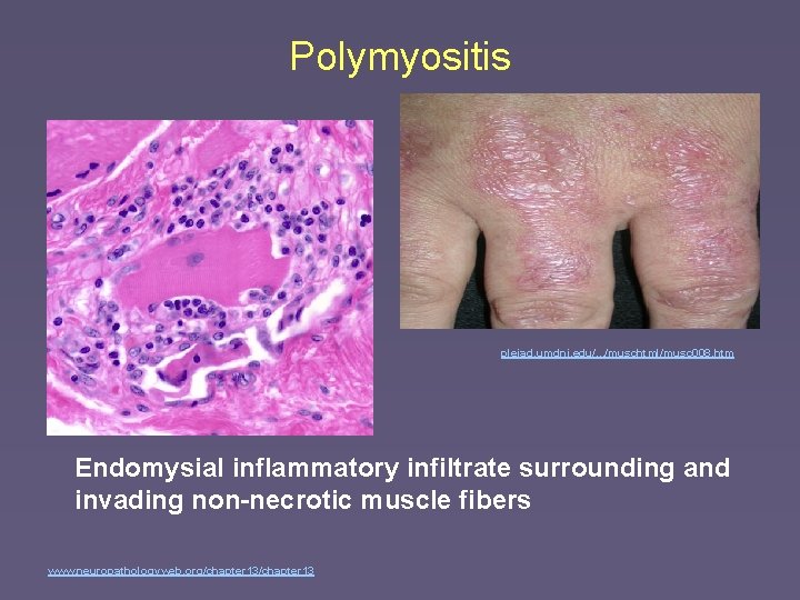 Polymyositis pleiad. umdnj. edu/. . . /muschtml/musc 008. htm Endomysial inflammatory infiltrate surrounding and