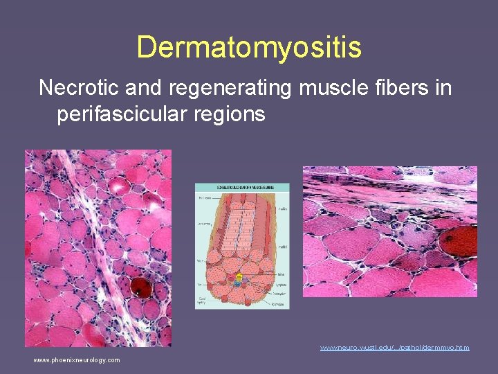 Dermatomyositis Necrotic and regenerating muscle fibers in perifascicular regions www. neuro. wustl. edu/. .