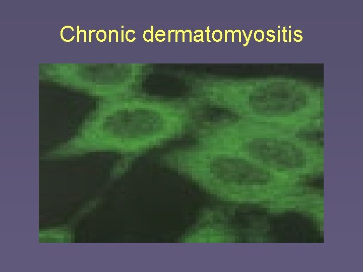 Chronic dermatomyositis 