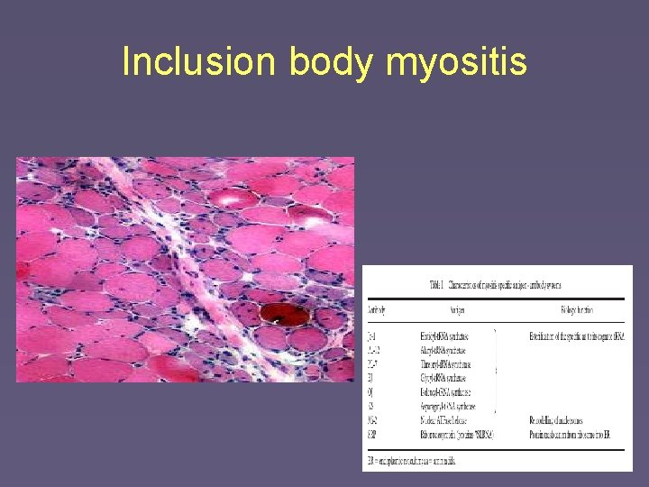 Inclusion body myositis 