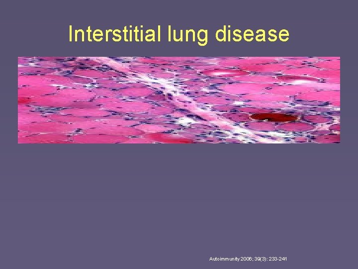 Interstitial lung disease Autoimmunity 2006; 39(3): 233 -241 