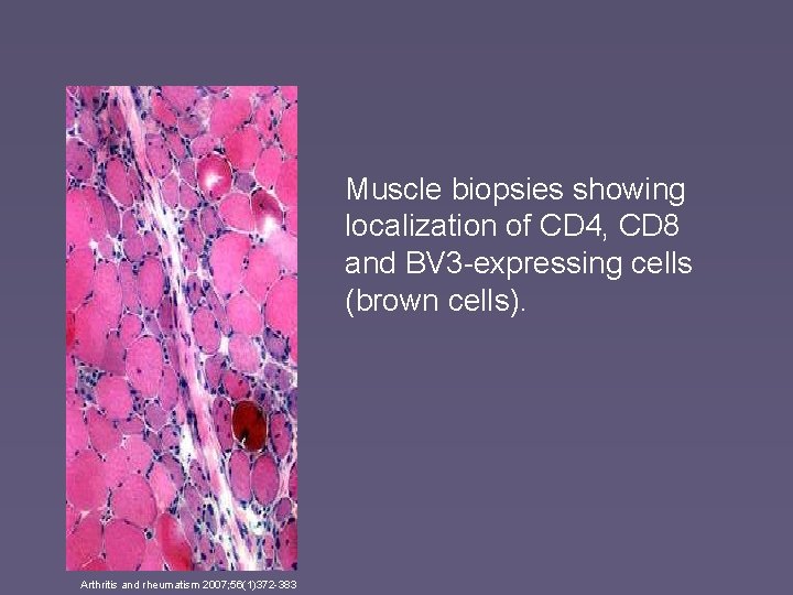 Muscle biopsies showing localization of CD 4, CD 8 and BV 3 -expressing cells