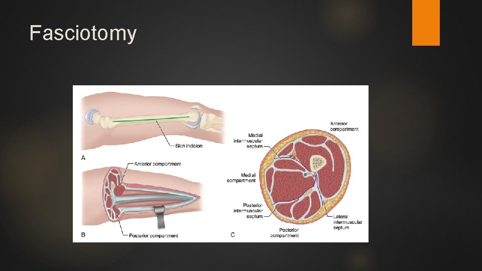 Fasciotomy 