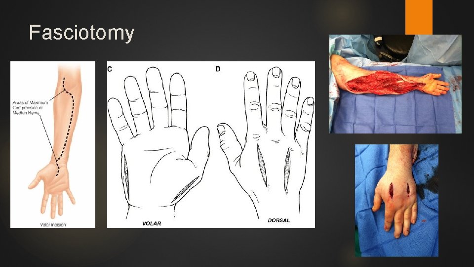 Fasciotomy 