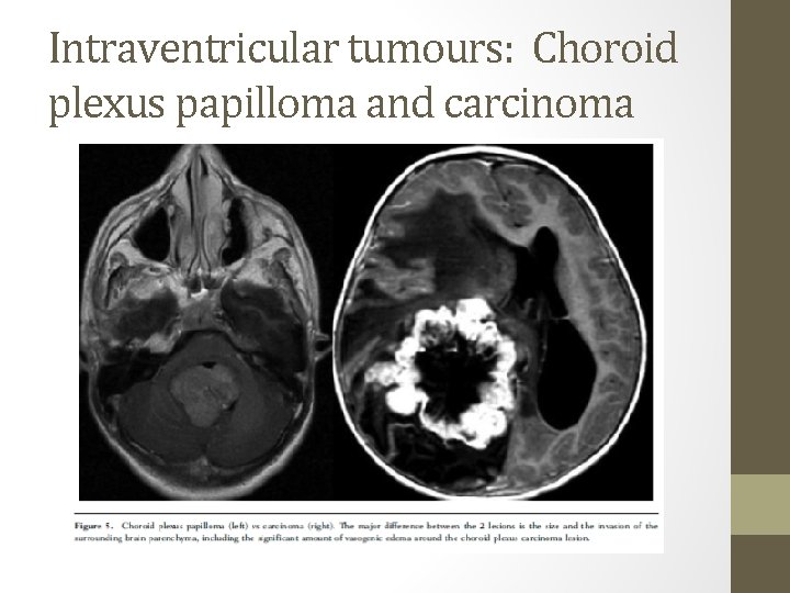 Choroid papilloma tumor, Choroid plexus papilloma vs carcinoma mri - Choroid plexus papilloma tumor