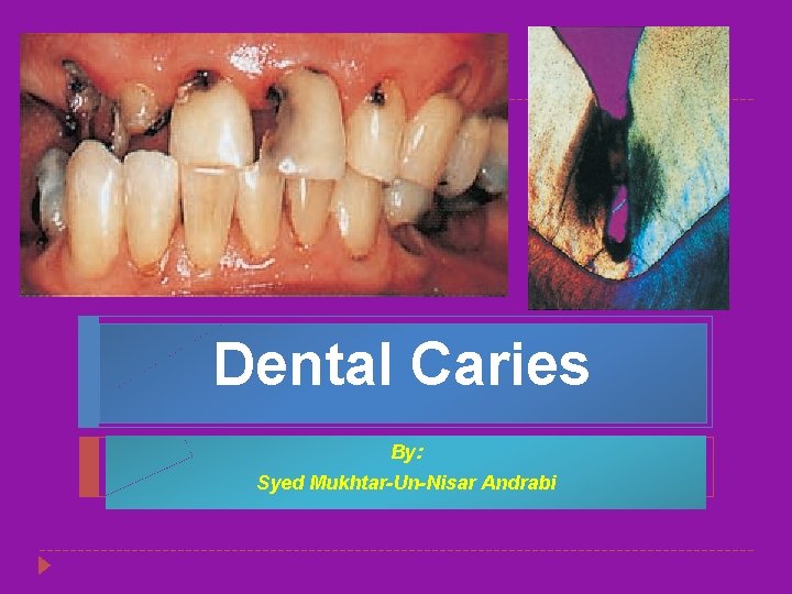 Dental Caries By: Syed Mukhtar-Un-Nisar Andrabi 