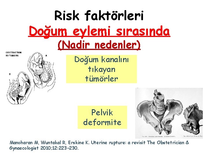 Risk faktörleri Doğum eylemi sırasında (Nadir nedenler) Doğum kanalını tıkayan tümörler Pelvik deformite Manoharan