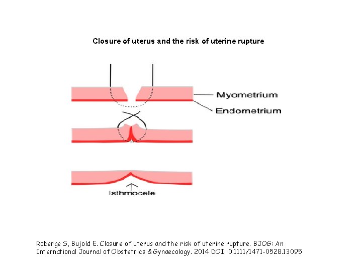 Closure of uterus and the risk of uterine rupture Roberge S, Bujold E. Closure