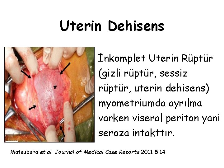 Uterin Dehisens İnkomplet Uterin Rüptür (gizli rüptür, sessiz rüptür, uterin dehisens) myometriumda ayrılma varken