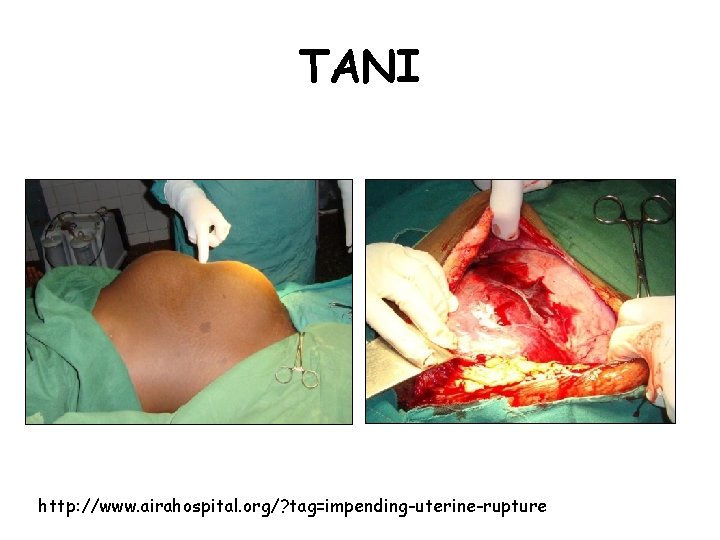 TANI http: //www. airahospital. org/? tag=impending-uterine-rupture 