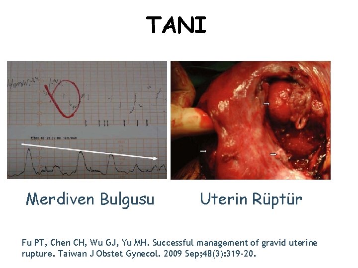 TANI Merdiven Bulgusu Uterin Rüptür Fu PT, Chen CH, Wu GJ, Yu MH. Successful