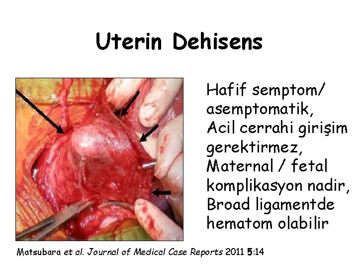 Uterin Dehisens Hafif semptom/ asemptomatik, Acil cerrahi girişim gerektirmez, Maternal / fetal komplikasyon nadir,