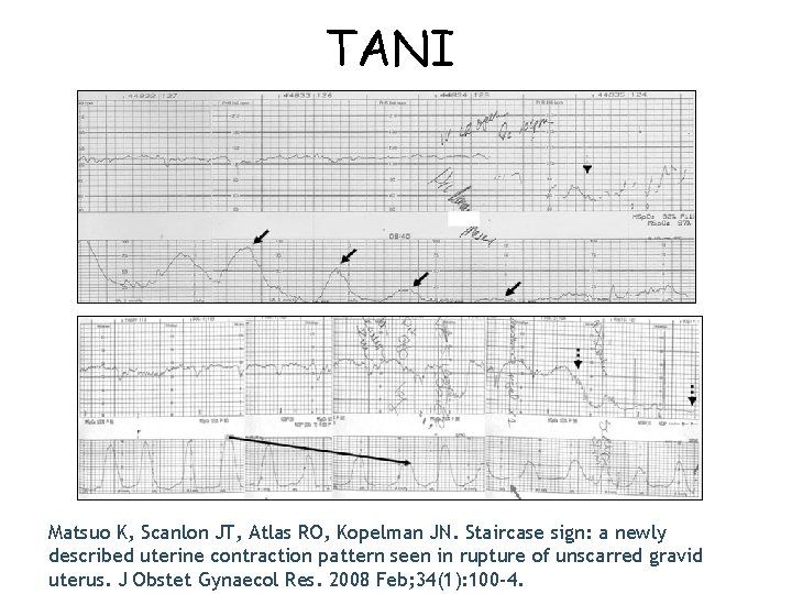 TANI Matsuo K, Scanlon JT, Atlas RO, Kopelman JN. Staircase sign: a newly described