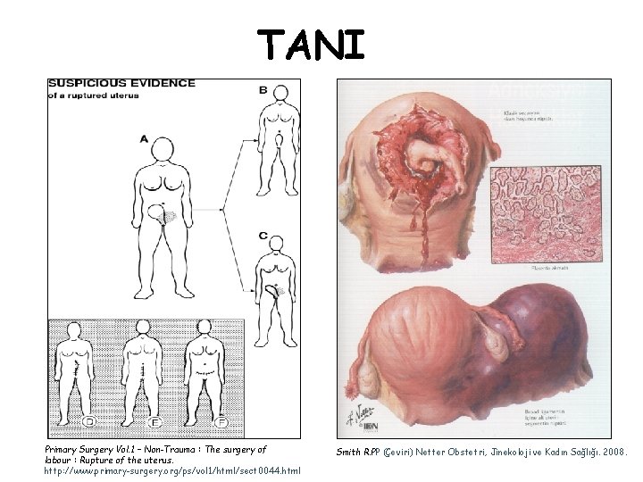 TANI Primary Surgery Vol. 1 – Non-Trauma : The surgery of labour : Rupture