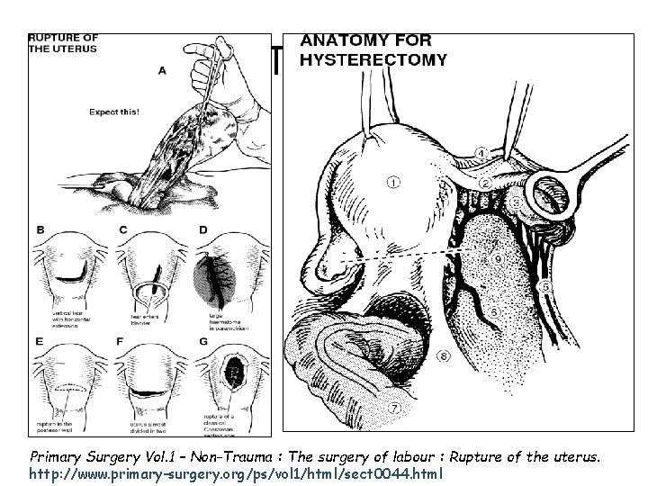 Tedavi Primary Surgery Vol. 1 – Non-Trauma : The surgery of labour : Rupture