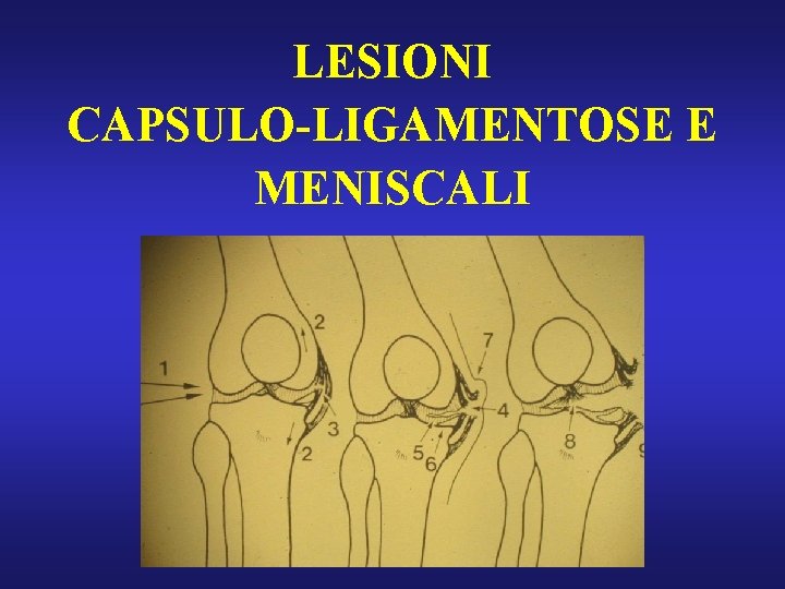 LESIONI CAPSULO-LIGAMENTOSE E MENISCALI 