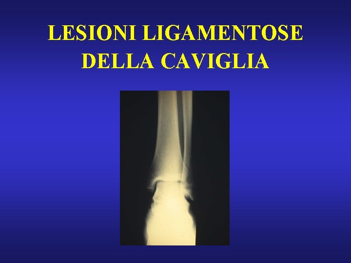 LESIONI LIGAMENTOSE DELLA CAVIGLIA 