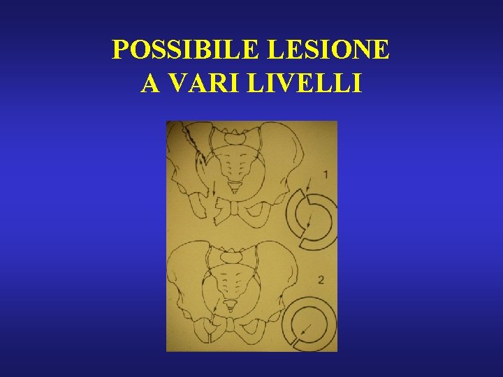 POSSIBILE LESIONE A VARI LIVELLI 