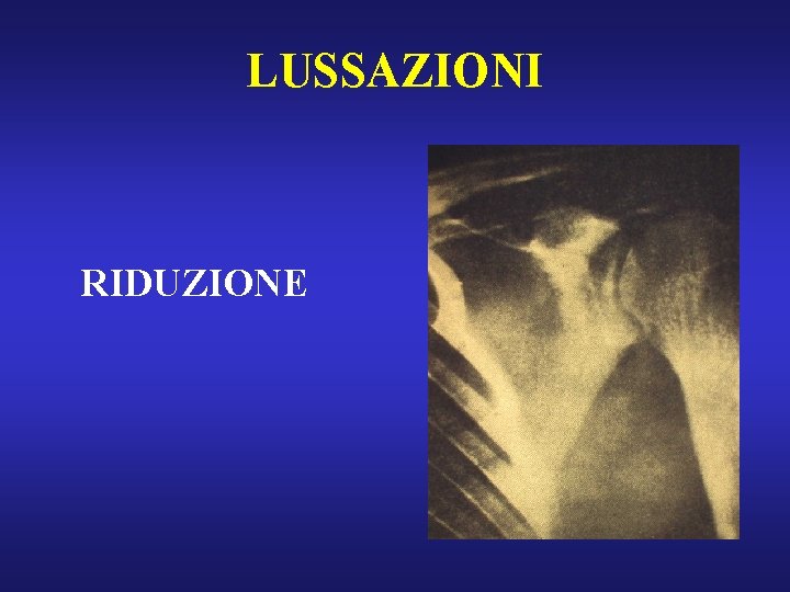 LUSSAZIONI RIDUZIONE 