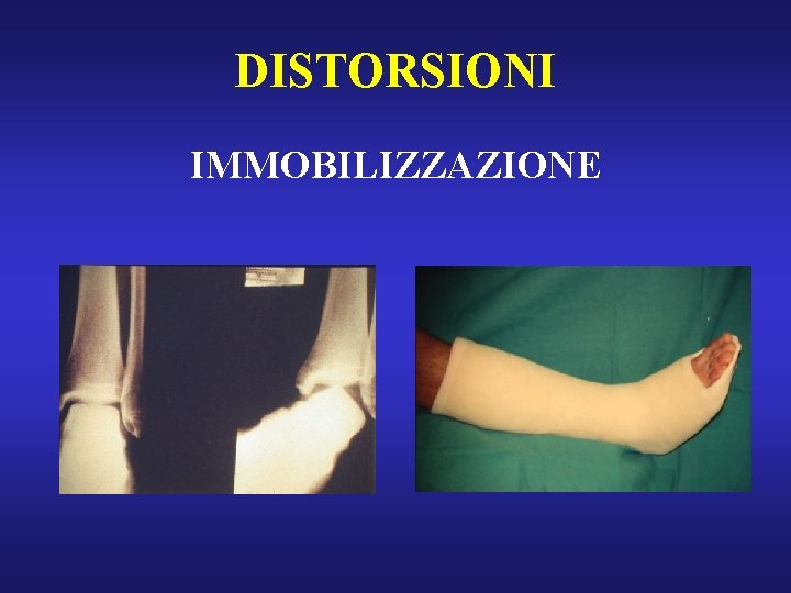 DISTORSIONI IMMOBILIZZAZIONE 