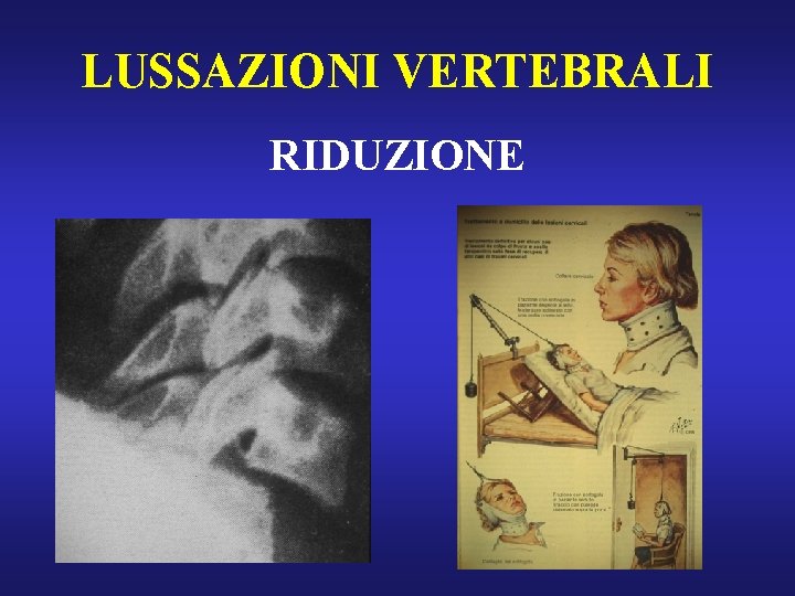 LUSSAZIONI VERTEBRALI RIDUZIONE 