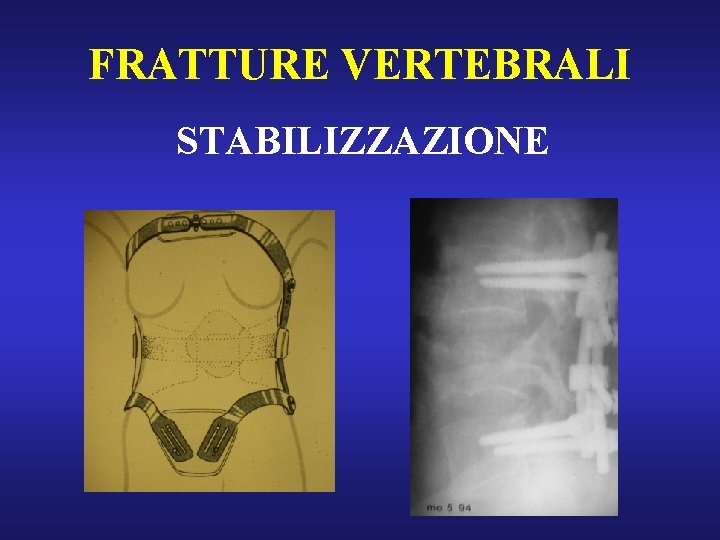 FRATTURE VERTEBRALI STABILIZZAZIONE 