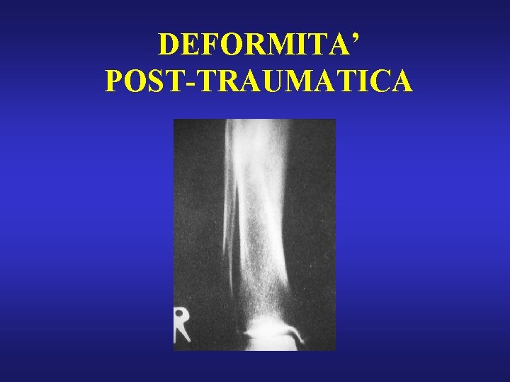DEFORMITA’ POST-TRAUMATICA 